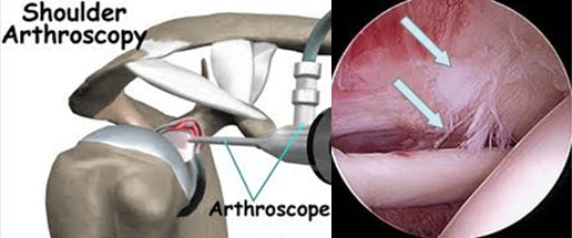 arthoscopy arthoscopy