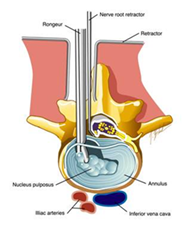 Μικροδισκεκτομή: μέσω μιας μικρής τομής, ένα ενδοσκόπιο εισάγεται και η πρόπτωση του δίσκου εκτέμνεται. mikrodietomi