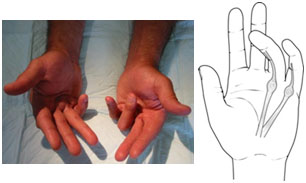Η νόσος του Dupuytren εμφανίζεται με εξογκώματα (οζίδια) κάτω από το δέρμα που αναπτύσσονται κατά μήκος της παλαμιαίας απονεύρωσης. Σε προχωρημένο στάδιο προκαλείται η παραμόρφωση της σύγκαμψης στα δάκτυλα. nosos