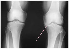 osteoarthitida-stenosi osteoarthitida stenosi