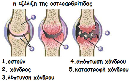 osteoarthritida-gonatos osteoarthritida gonatos