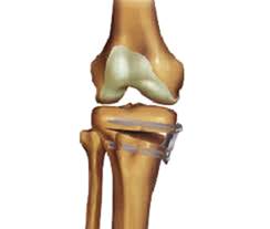 osteoarthritida-sportsurgery osteoarthritida sportsurgery