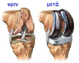 osteoarthritides osteoarthritides