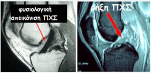 Ρήξη προσθίου χιαστού rixi pxs 300x146