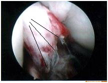 Torn ACL (αρθροσκοπική εικόνα στη ρήξη ΠΧΣ) torn